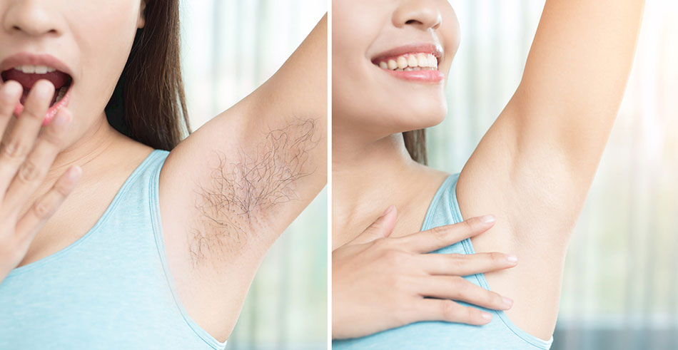 laser-hair-removal-before-and-after-2118145