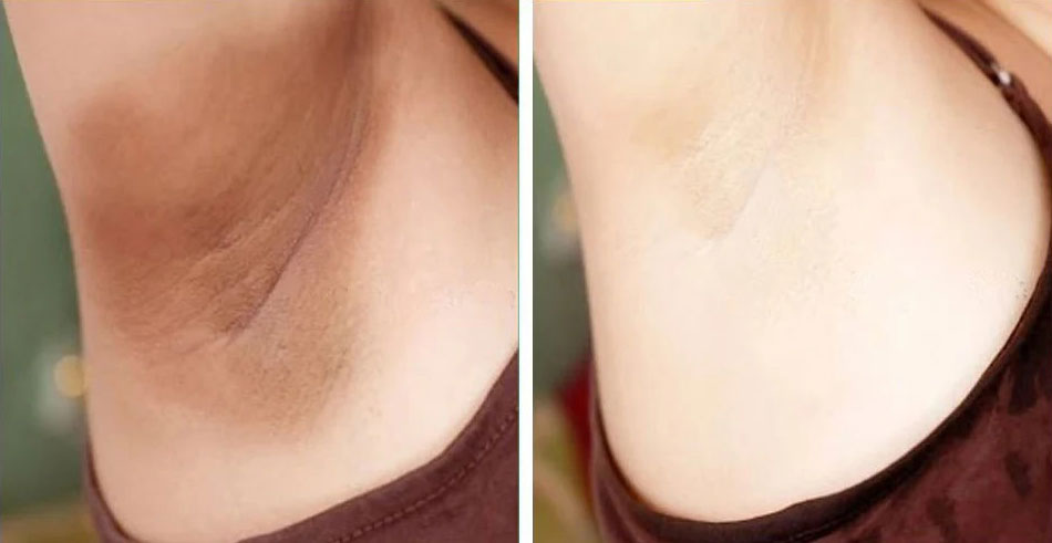 laser-hair-removal-before-and-after-5448