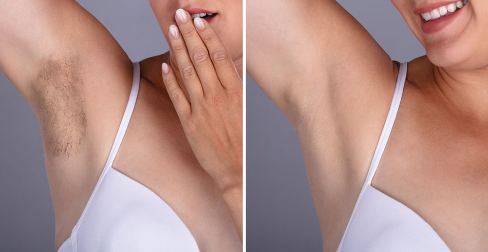 laser-hair-removal-before-and-after-559